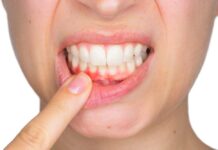 Gum Swelling & How To Stop It