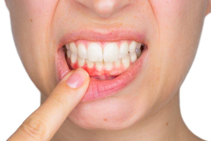Gum Swelling & How To Stop It