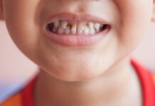 How to Prevent and Treat Early Childhood Caries