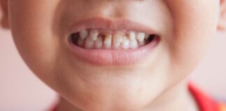 How to Prevent and Treat Early Childhood Caries