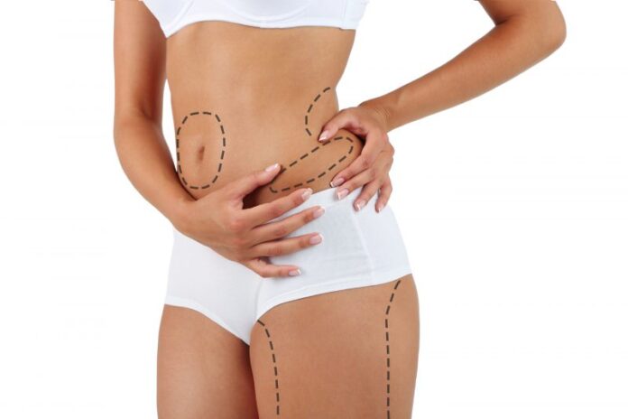 The Benefits and Risks of Liposuction: Is It Right for You