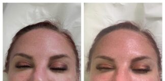 Before and After My Hydrafacial Treatment in London